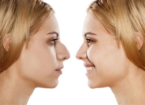 The Psychological Impact of Rhinoplasty Surgery